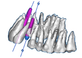 Simplant CT Diagnostic