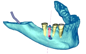 Simplant CT Diagnostic